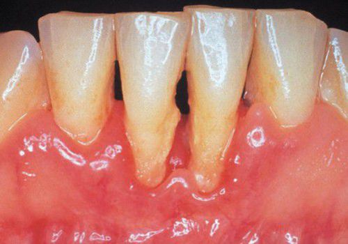 Cạo vôi răng có đau không? 3