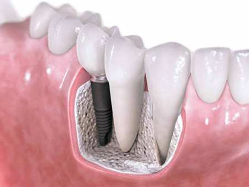 Cấy ghép Implant thay thế răng đã mất như răng thật