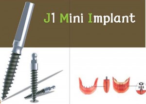 Cấy ghép mini Implant