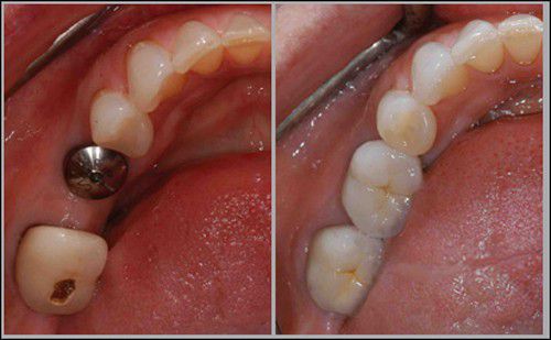 Cấy ghép răng Implant có đau không? 1