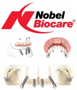 Giá Implant Nobel Biocare