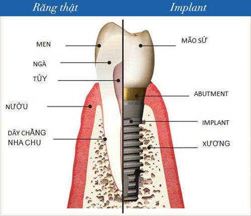 Giá trồng răng Implant