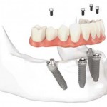 Giá trồng răng Implant
