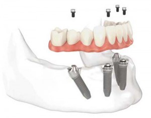 Giá trồng răng Implant