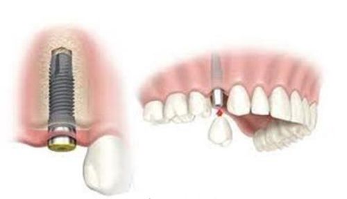  Implant giải pháp phục hồi răng hoàn hảo
