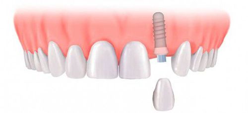 Implant khi mất một răng