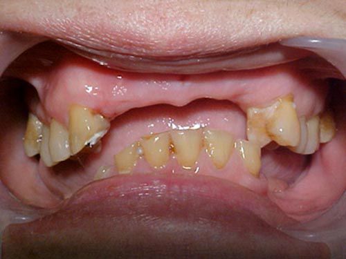 Implant khi mất nhiều răng