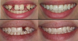 Implant sau khi nhổ răng