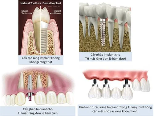Kỹ thuật cấy ghép răng Implant 1