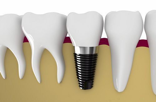 Kỹ thuật cấy ghép răng Implant