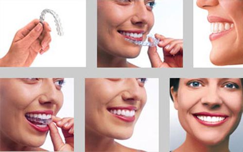 Niềng răng không cần nhổ răng 3