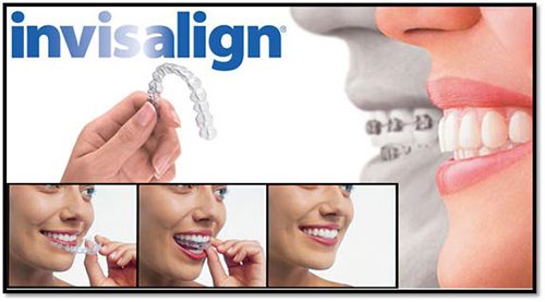 Niềng răng không mắc cài invisalign giá bao nhiêu tiền? 1
