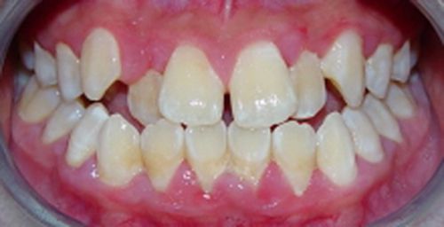 Niềng răng không mắc cài invisalign giá bao nhiêu tiền? 2