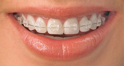 Niềng răng mắc cài sứ dây trong 3