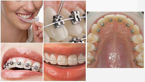 Niềng răng mắc cài sứ tự buộc 1
