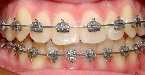  Niềng răng mắc cài tự đóng 2