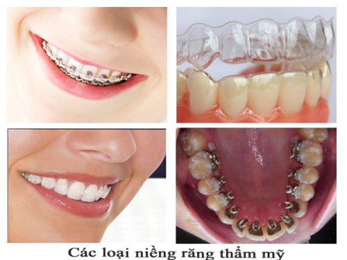 Niềng răng móm giá bao nhiêu tiền? 1