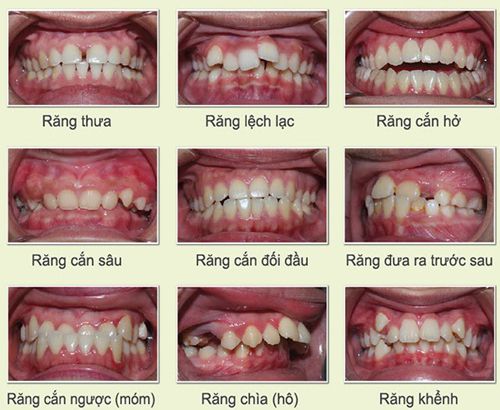 Niềng răng trong suốt giá bao nhiêu tiền? 2