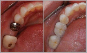 Quy trình cấy ghép răng Implant an toàn