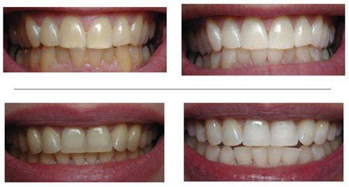  Tẩy trắng răng có hại gì không?
