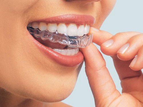 Tẩy trắng răng có hại gì không? 2