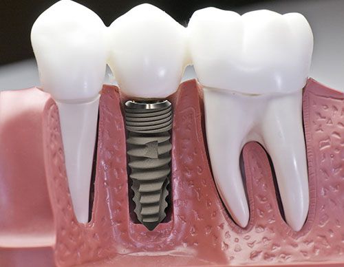 Ưu điểm vượt trội của cấy ghép răng Implant