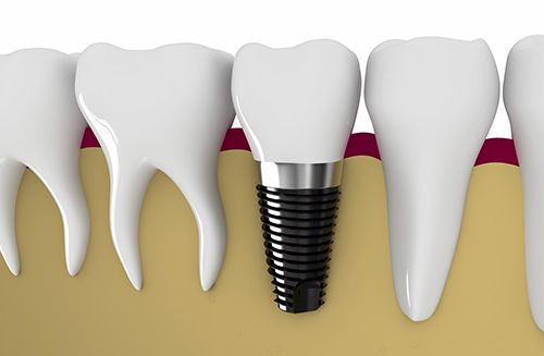  Răng Implant sử dụng được bao lâu?
