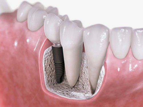  Răng Implant sử dụng được bao lâu?