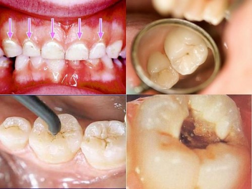 Bệnh lý sâu răng 1