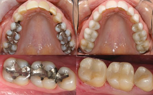 Bệnh lý sâu răng 3