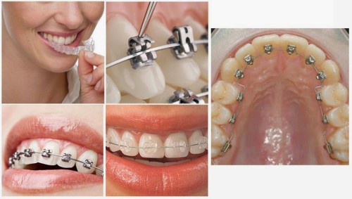 Các dạng niềng răng mắc cài 1