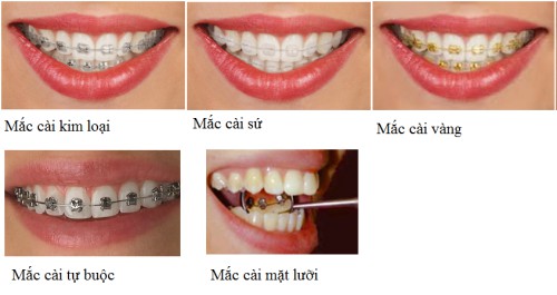 Các dạng niềng răng mắc cài 2