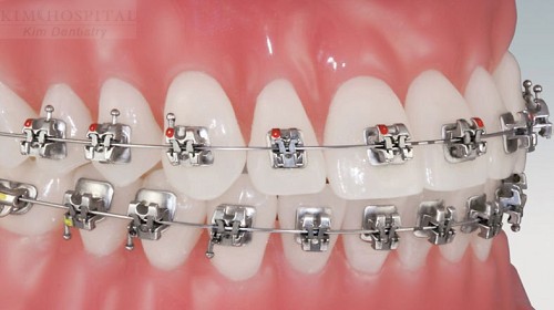 Độ tuổi thích hợp để niềng răng 4