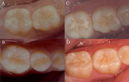 Cách điều trị và phòng bệnh sâu răng 1