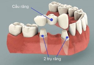 Cầu răng có phải là phương pháp trồng răng vĩnh viễn không?
