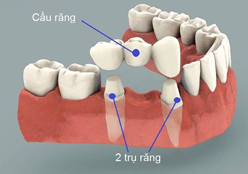 Cầu răng có phải là phương pháp trồng răng vĩnh viễn không? 2