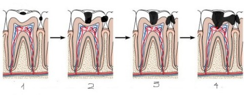 Điều trị sâu răng hiệu quả 1