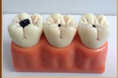 Phát hiện sâu răng sớm 2