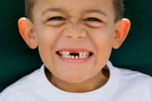 Hậu quả của bệnh sâu răng 2