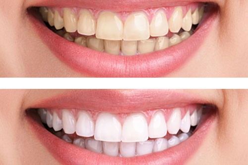 Hiệu quả của tẩy trắng răng