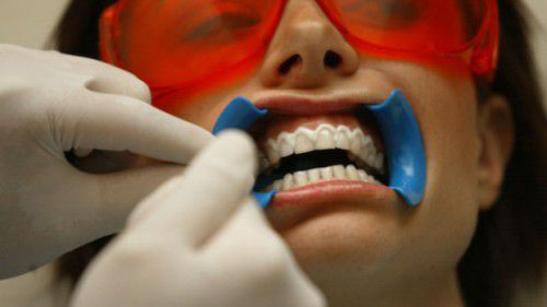 Tẩy trắng răng có làm yếu men răng