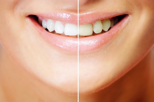Tẩy trắng răng duy trì trong bao lâu? 2