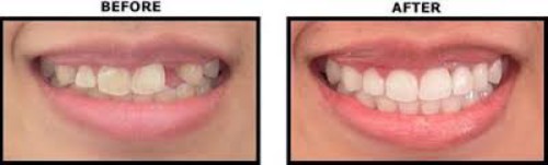 Bọc răng sứ thẩm mỹ giải pháp phục hình cho răng mất 1