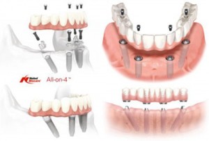 Kỹ thuật Implant all on 4 là gì?