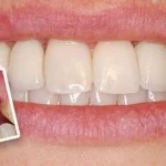 Nhổ răng đồng thời cấy ghép Implant