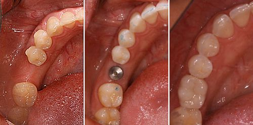 Nhổ răng đồng thời cấy ghép Implant