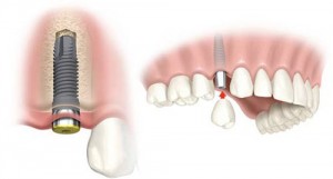 Tiêu chí đánh giá Implant tốt hay không?