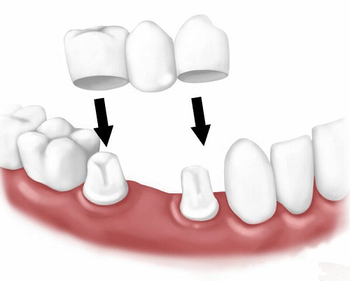 Trồng răng giả có đau không? Tìm hiểu thêm 2