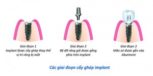 Cấy ghép răng implant giá bao nhiêu ?
