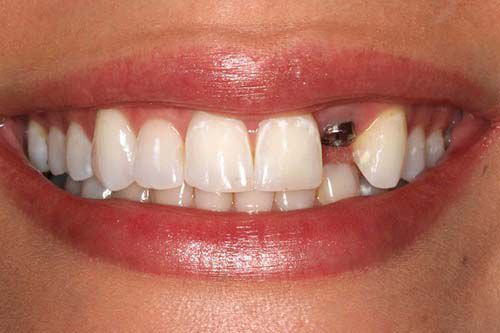 Trồng răng giả bằng phương pháp cấy ghép Implant 4